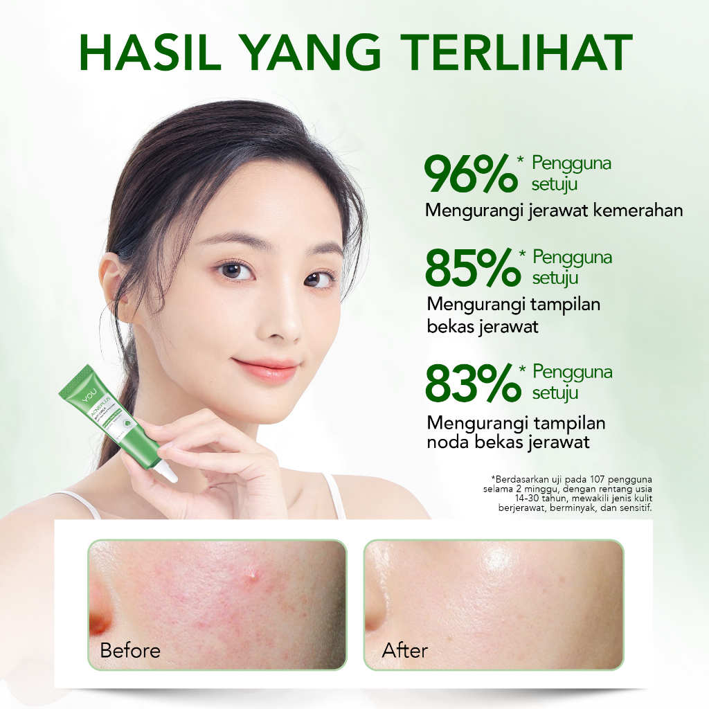 YOU Acneplus Triple Action Spot Care X 15gr YOU Acneplus Triple Action Spot Care X 15gr